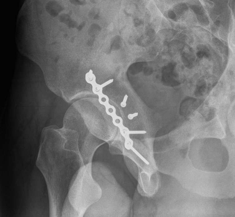 Acetabulum Posterior Wall Plating 3